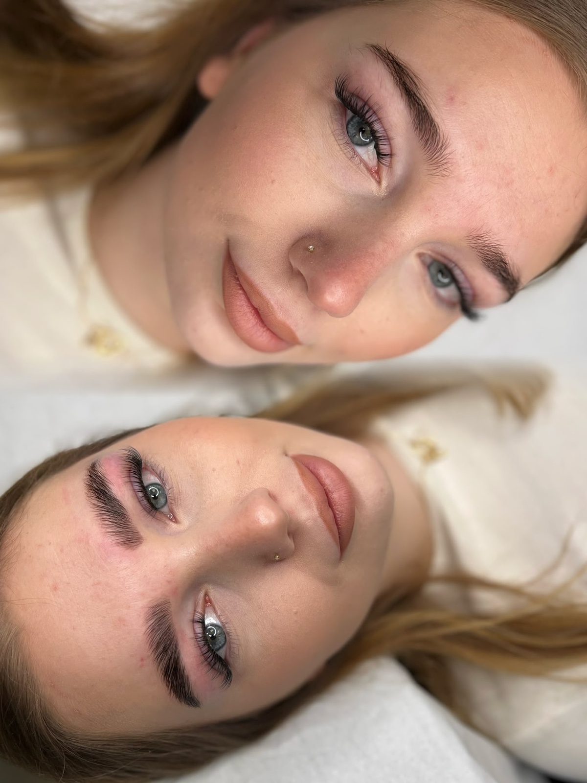Brow-Lifting